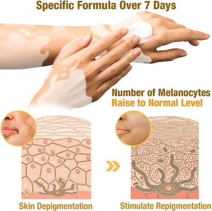New Vitigo Bee Venom Treatment Cream for Skin